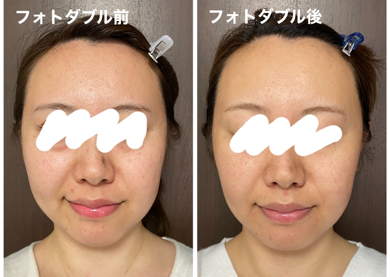 フォトダブル1回目照射前後の比較