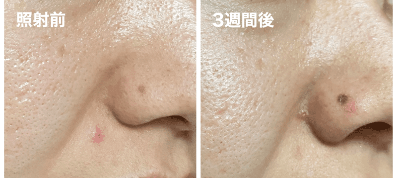 フォトダブル後の紫外線でシミが悪化した様子