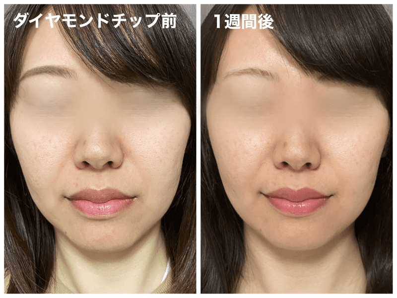 【ポテンツァ】品川美容外科（品川スキンクリニック）で実際にダイヤモンドチップを受けてみた感想ブログ