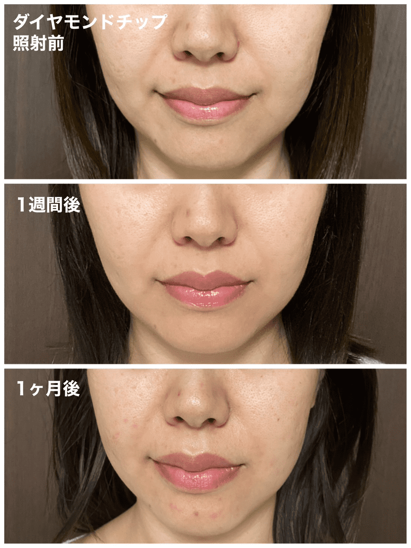 【ポテンツァ】品川美容外科（品川スキンクリニック）で実際にダイヤモンドチップを受けてみた感想ブログ